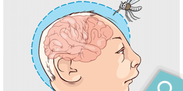 Microcefalia: 18 causas além do Zika vírus