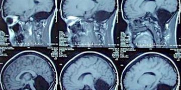 Agenesia do cerebelo: é possível ter uma vida normal sem essa parte do cérebro?