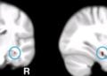 A relação entre o Alzheimer e o cálcio