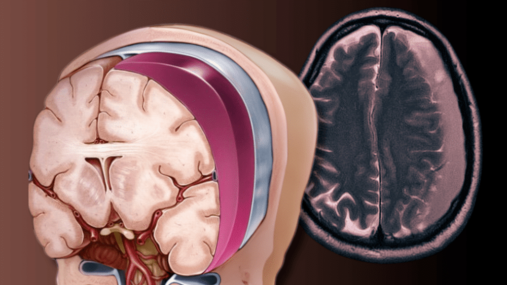 hematoma subdural causa diagnóstico tratamento sequelas