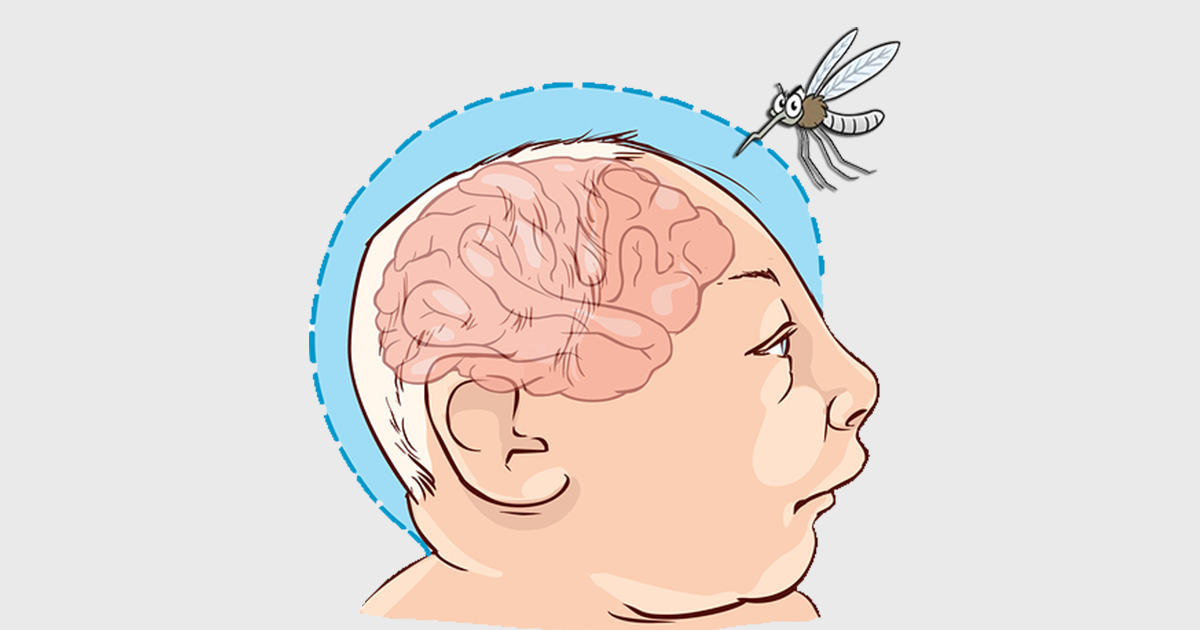 microcefalia-zika-virus-outras-causas