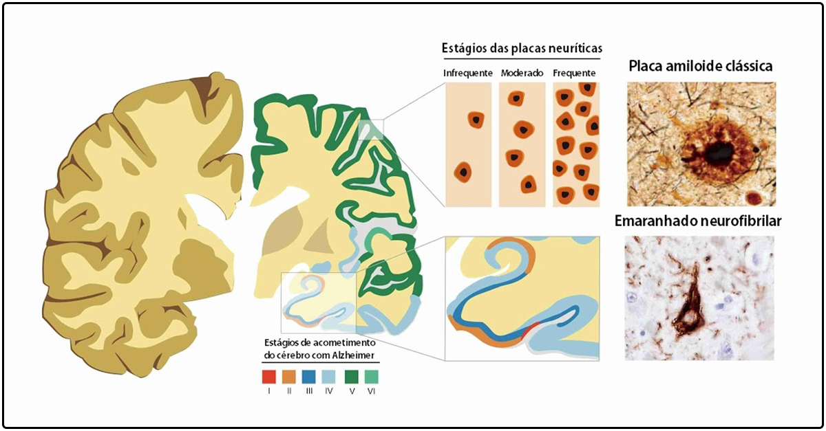 alzheimer-placas-senis-emaranhados-neurofibrilares-lesoes-cerebrais-genes