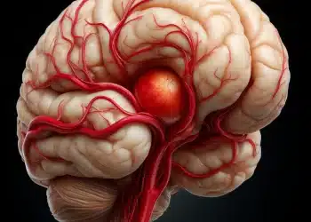 O que é aneurisma cerebral? Quais os sintomas, causas e formas de tratamento? Aneurisma cerebral tem cura?
