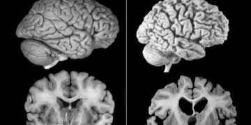 Um cérebro mais resistente à doença de Alzheimer? Como isso é possível?