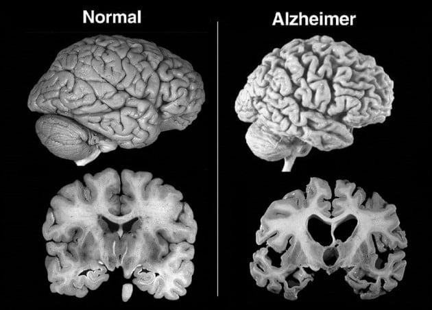 Atrofia cerebral significativa e cérebro mais resistente à doença de Alzheimer