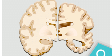 Alzheimer: as lesões cerebrais predominantes e os genes envolvidos