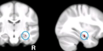 A relação entre o Alzheimer e o cálcio
