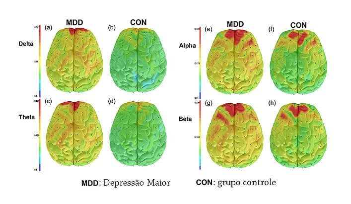 cérebro deprimido e conexões neurais