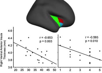 Estudo correlaciona maior dependência e exposição ao cigarro e diminuição do córtex insular