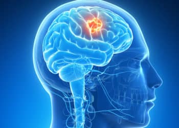 Câncer no cérebro: uma nova esperança