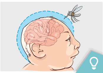 Microcefalia: 18 causas além do Zika vírus