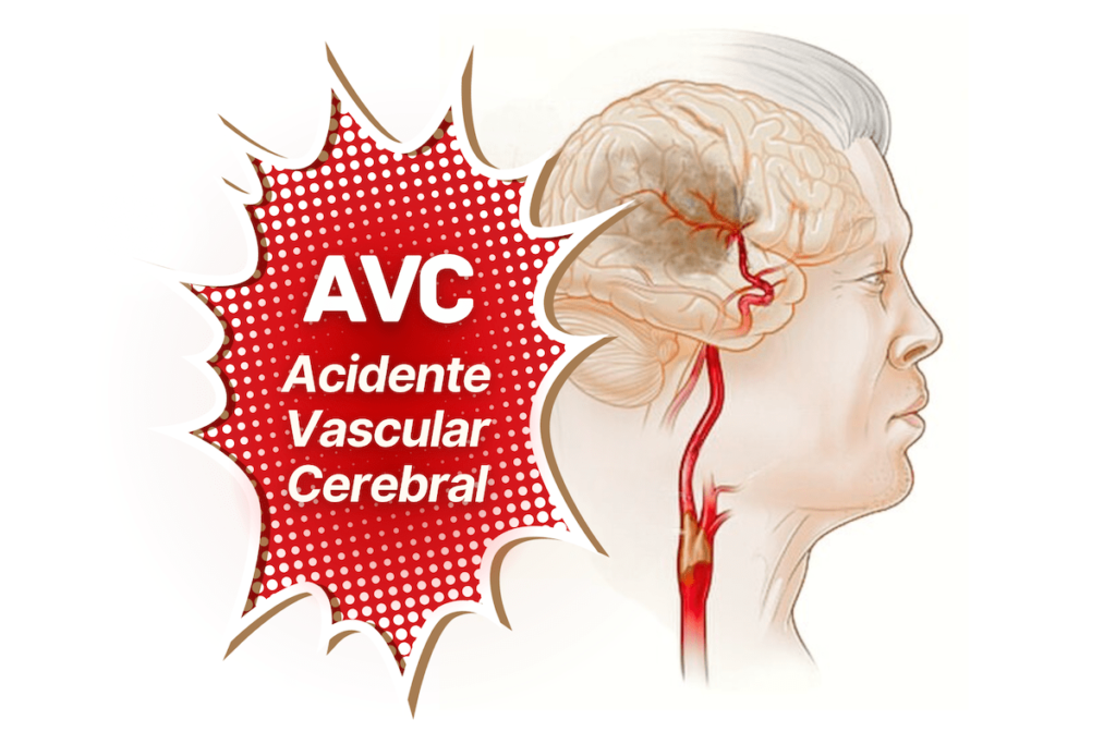 AVC Acidente Vascular Cerebral