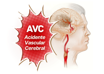 AVC Acidente Vascular Cerebral